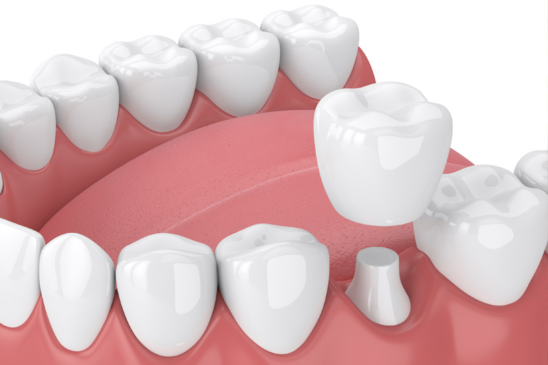 Dental Crowns in Plano