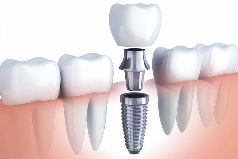 Implants Dentist in Plano