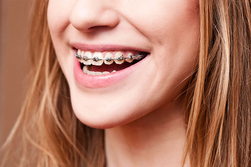 Orthodontics in Plano