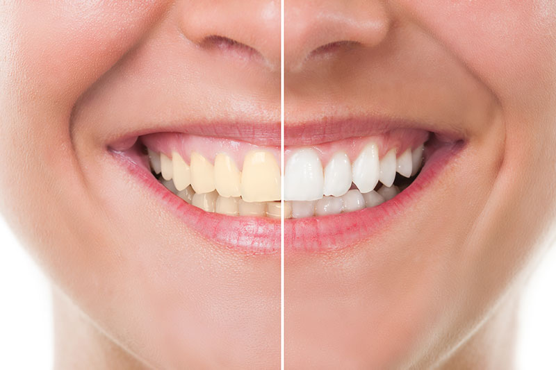 Teeth Whitening in Plano