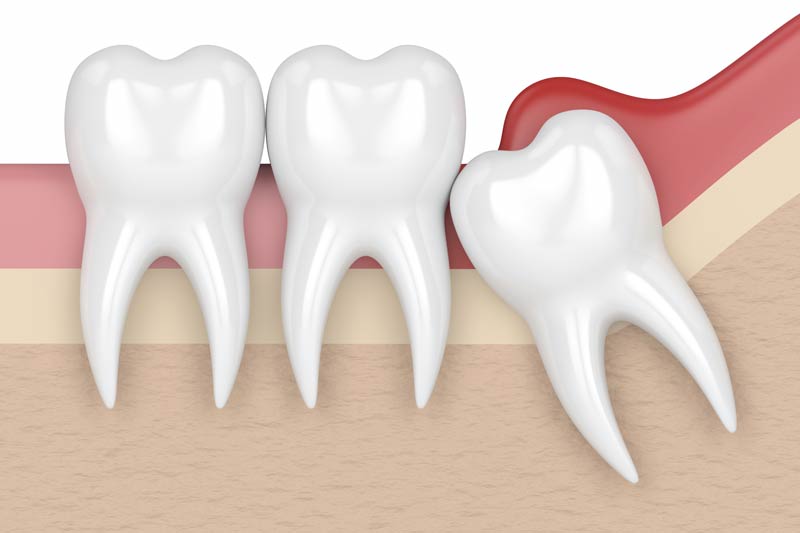 Wisdom Tooth Removal in Plano